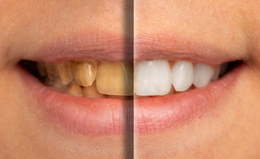 Can Yellow Teeth Be Whitened? (Yes, Here’s How)