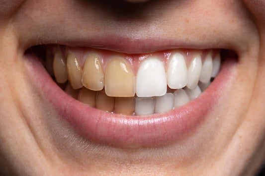 How to Remove Stains From Teeth? (Effective Solutions + Tips)