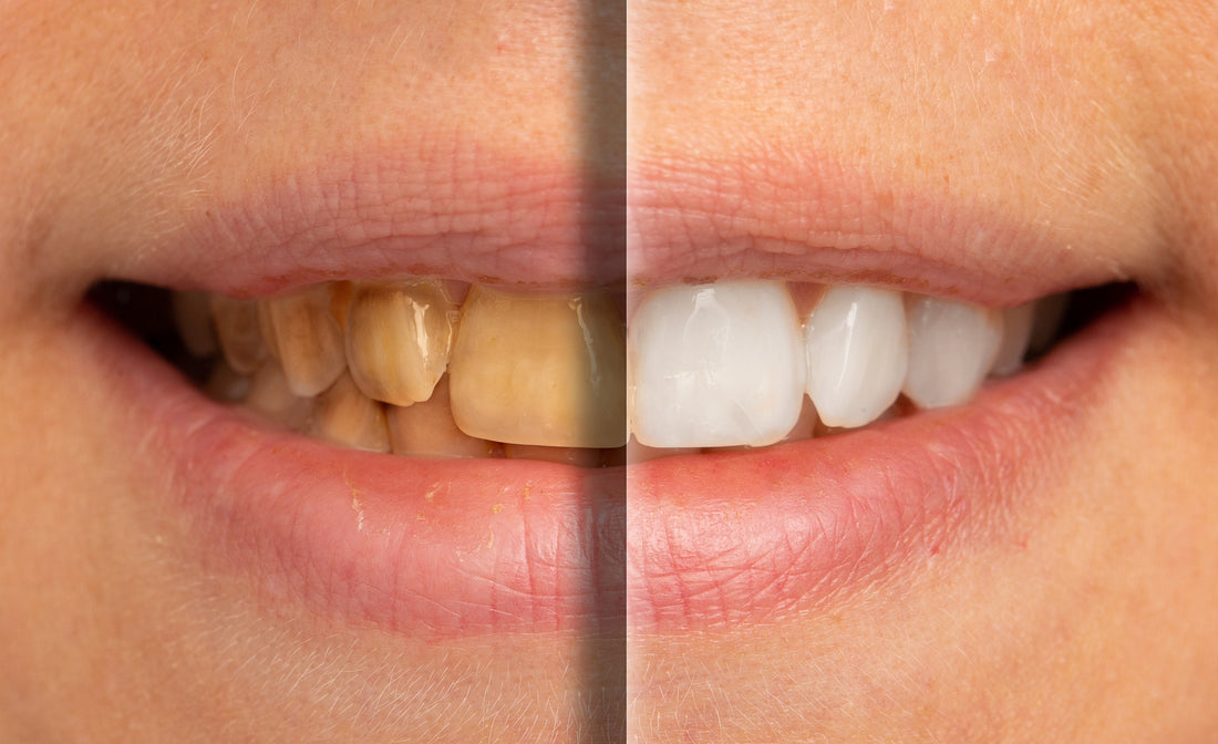 Can Yellow Teeth Be Whitened? (Yes, Here’s How)